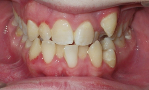 http://www.saxeortho.com/images/crowding.jpg