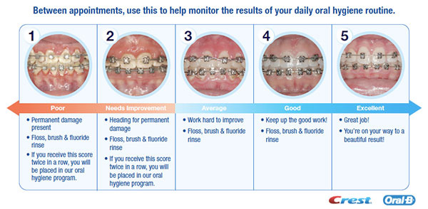 Braces Chart