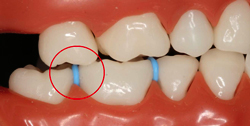 spacers braces teeth separators orthodontic bands between before extraction ortho rubber orthodontics dental metal types bottom appliances science molar orthodontist